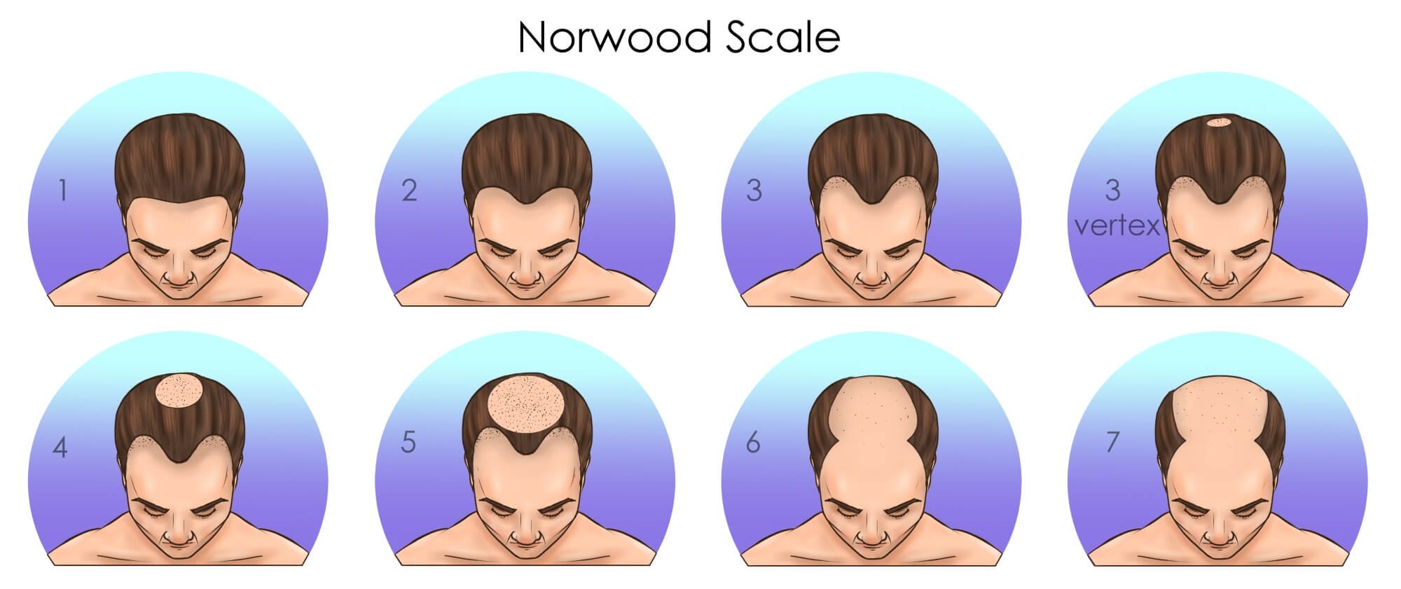 Norwood Hair Loss Scale