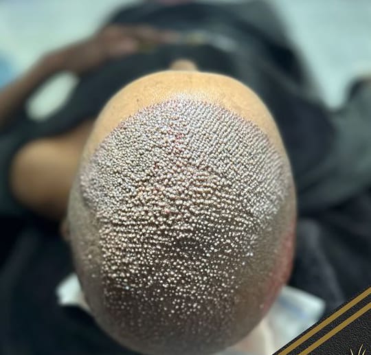 Hair Transplant